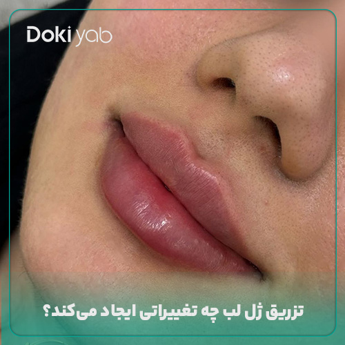 بررسی تغییراتی که ژل لب ایجاد می‌کند