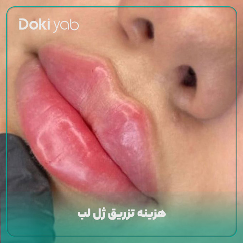 هزینه تزریق ژل لب 