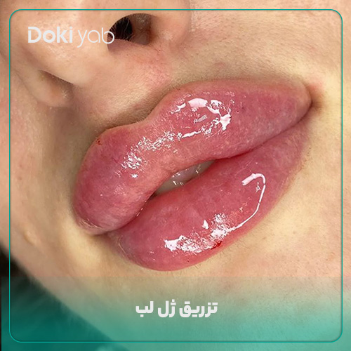 عکس تزریق ژل لب