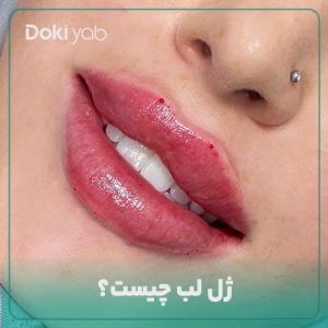ژل لب چیست؟ 7 مدل تزریق + بهترین دکتر + برندها + هزینه