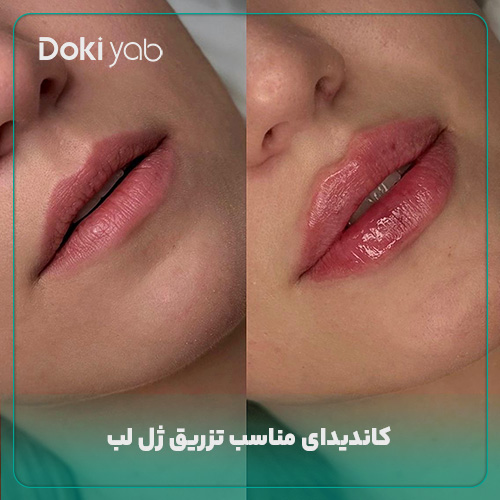 معرفی کاندیدای مناسب تزریق ژل لب
