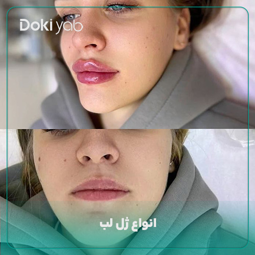 معرفی انواع ژل لب