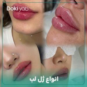 انواع ژل لب؛ 9 مدل معروف + عکس (طبیعی تا فانتزی)