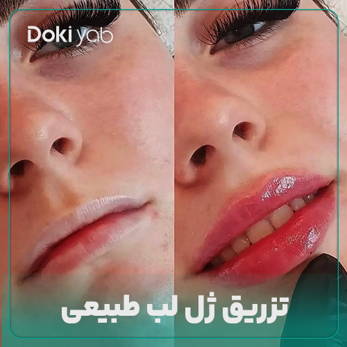 تزریق ژل لب طبیعی در شیراز با دکی یاب