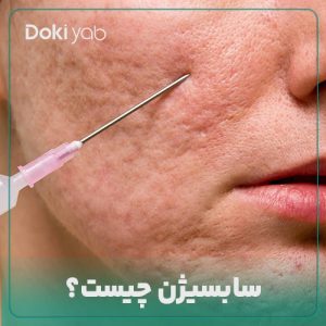 سابسیژن چیست؟ همه چیز در رابطه با سابسیژن صورت و رفع جای جوش