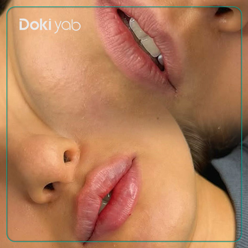 نمونه تزریق ژل لب صدفی