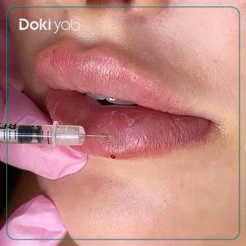 عکس تزریق لب صدفی