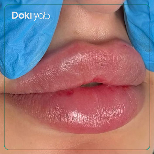 عکس تزریق ژل لب قلبی