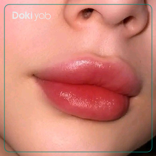 تزریق ژل لب به سبک قلوه‌ای