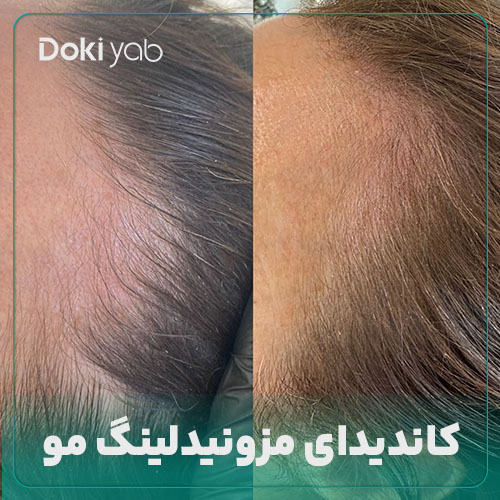 معرفی کاندیدای مناسب مزونیدلینگ مو