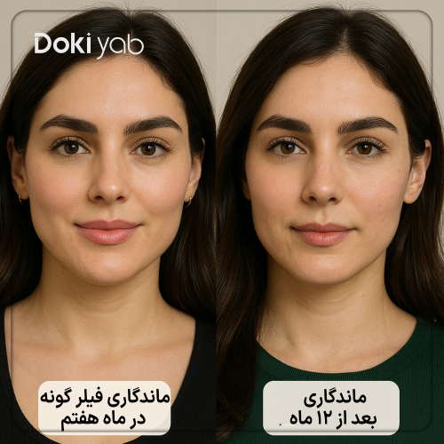 مقایسه ماندگاری فیلر آلیاکسین گونه بعد از دوازده ماه