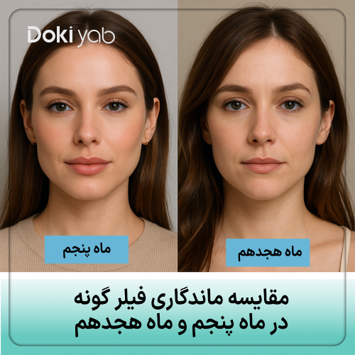 مقایسه ماندگاری فیلر استایلنج گونه در ماه پنجم و ماه هجدهم