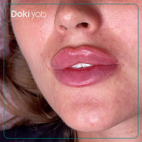نمونه تزریق ژل لب هالیوودی