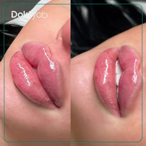 عکس فیلر لب هالیوودی