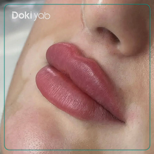 نمونه تزریق ژل لب روسی