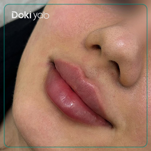 عکس تزریق ژل لب روسی