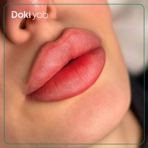 عکس نمونه‌کار تزریق ژل لب روسی