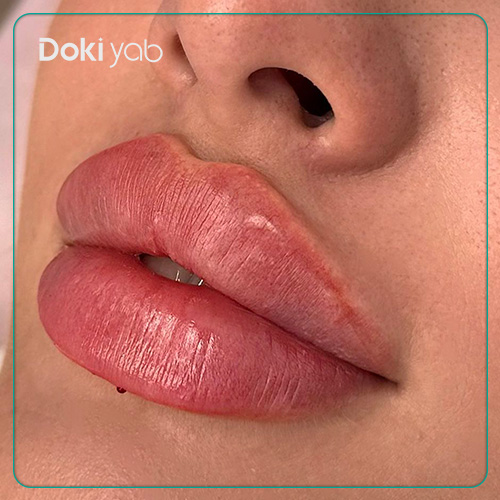 نمونه تزریق ژل لب سه دکمه‌ای 