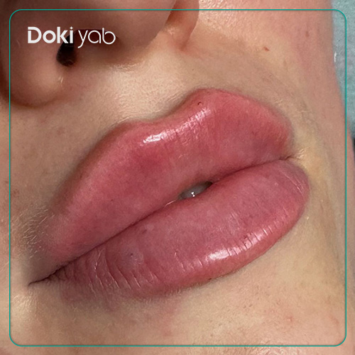 تزریق لب به سبک سه‌دکمه‌ای