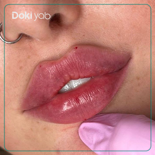 عکس تزریق لب سه‌دکمه‌ای