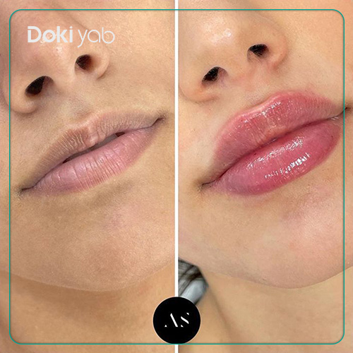 تصویر ژل لب طبیعی