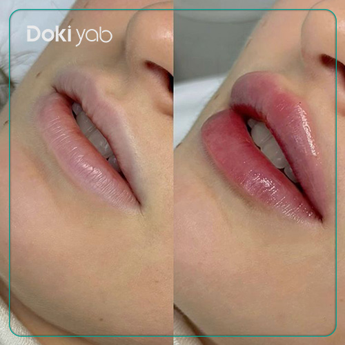 عکس نمونه کار تزریق ژل لب طبیعی