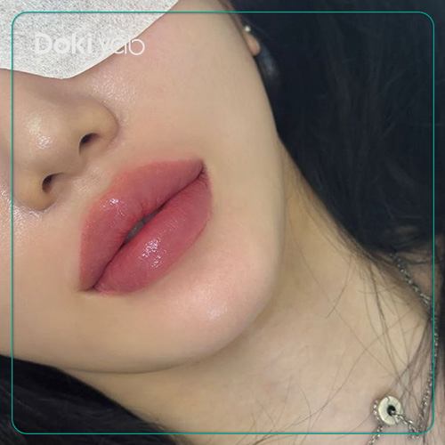 تزریق ژل لب عروسکی