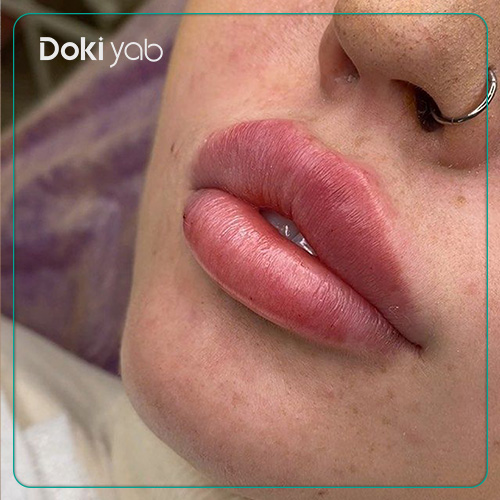 تزریق ژل لب به سبک گرد