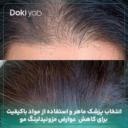 کاهش عوارض مزونیدلینگ مو