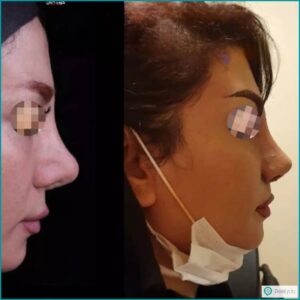 نمونه عمل بینی با دکتر بابک خسروانیان؛ جراح بینی در تهران