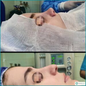 نمونه عمل بینی با دکتر بابک خسروانیان؛ جراح بینی در تهران