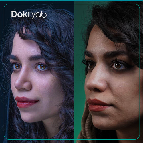 نمونه قبل و بعد از عمل بینی با بهترین جراح بینی در تهران؛ دکی یاب