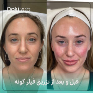 تزریق فیلر گونه در ۲۰۲۵ | تجربه واقعی، عکس‌های قبل و بعد، مزایا و عوارض کامل