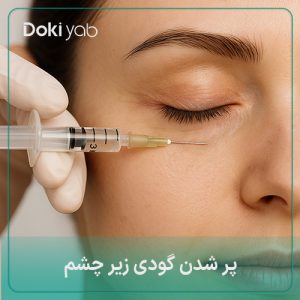 پر شدن گودی زیر چشم