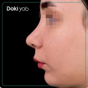 نمونه کار دکتر امیر دریانی جراح بینی تهران