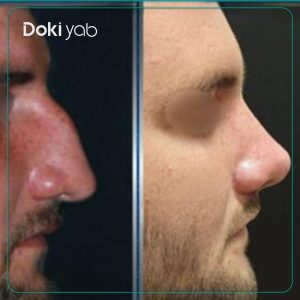 نمونه کار دکتر شروین سپنج جراح بینی در تهران