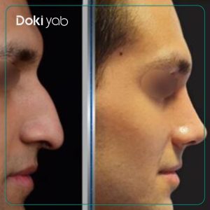 نمونه عمل بینی دکتر شروین سپنج در تهران