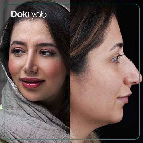 ویژگی‌های بینی نیمه فانتزی؛ نمونه جراحی بینی در تهران با دکی یاب