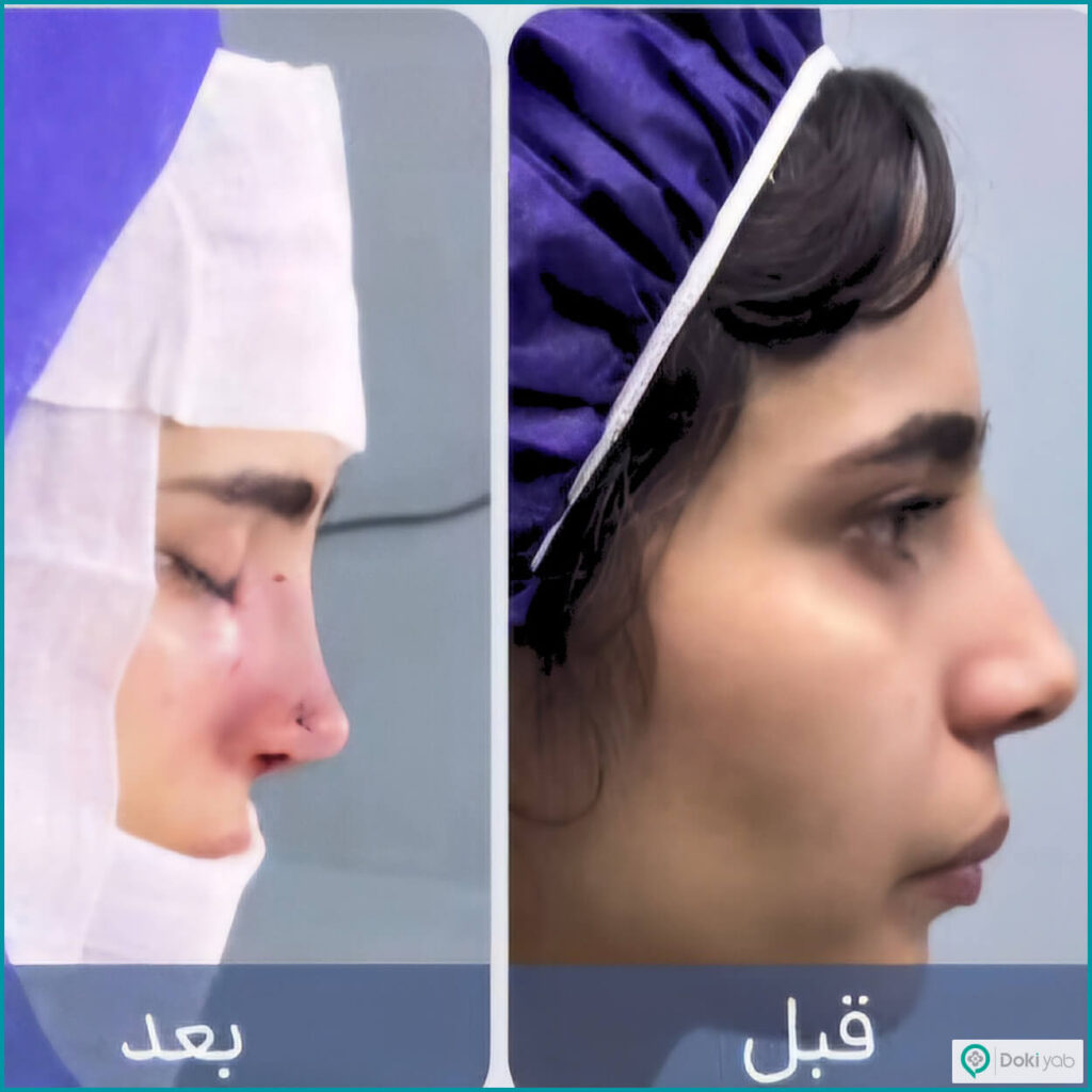 نمونه عمل بینی دکتر شهره اکرمی جراح بینی در تهران