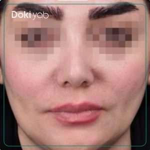 نمونه کار دکتر امیر دریانی جراح بینی در تهران