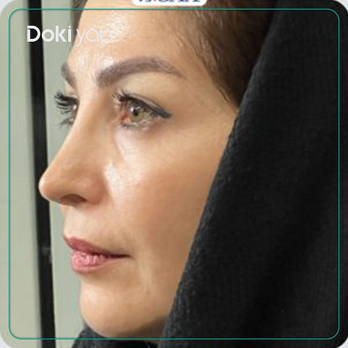 نمونه کار عمل بینی دکتر امیر دریانی جراح بینی در تهران