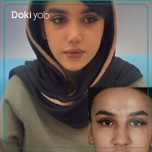 نمونه عمل بینی دکتر مسعود یزدانی جراح بینی در تهران