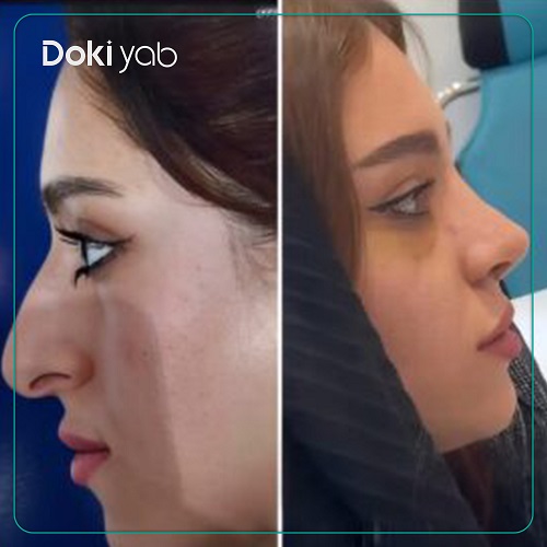 نمونه کار دکتر مسعود یزدانی جراح بینی در تهران