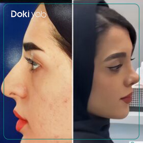 جراحی بینی با دکتر مسعود یزدانی در تهران
