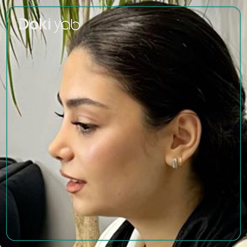 نمونه جراحی بینی دکتر امیر دریانی جراح بینی در تهران