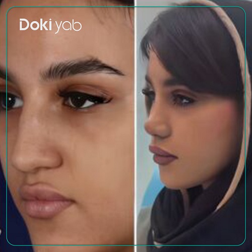 نمونه کار عمل بینی دکتر مسعود یزدانی تهران