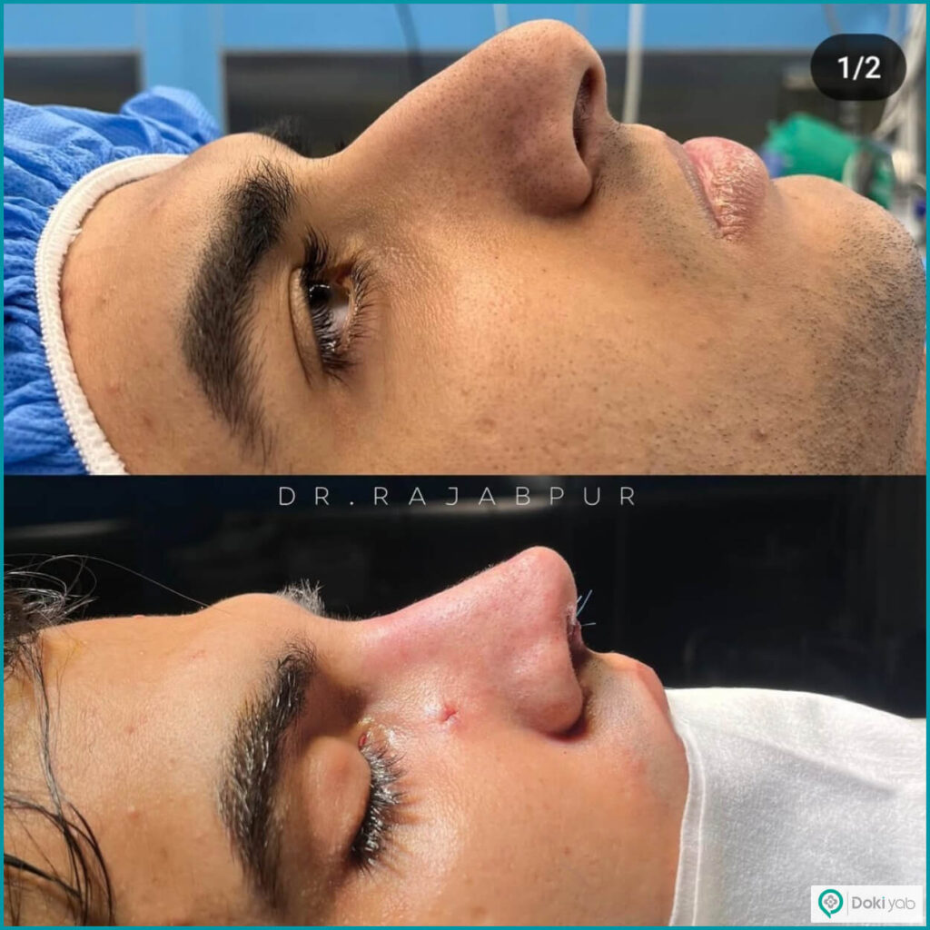 نمونه عمل بینی با دکتر احمد علی رجب پور جراح بینی در تهران