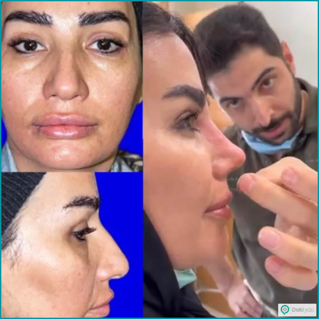 نمونه عمل بینی با دکتر احمد علی رجب پور جراح بینی در تهران
