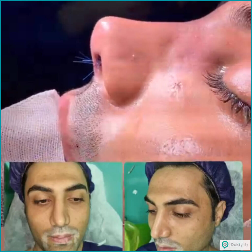 نمونه عمل بینی با دکتر احمد علی رجب پور جراح بینی در تهران