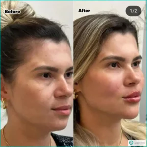 4 روش شگفت‌انگیز فرم دهی صورت بدون جراحی: زیبایی بدون دردسر!